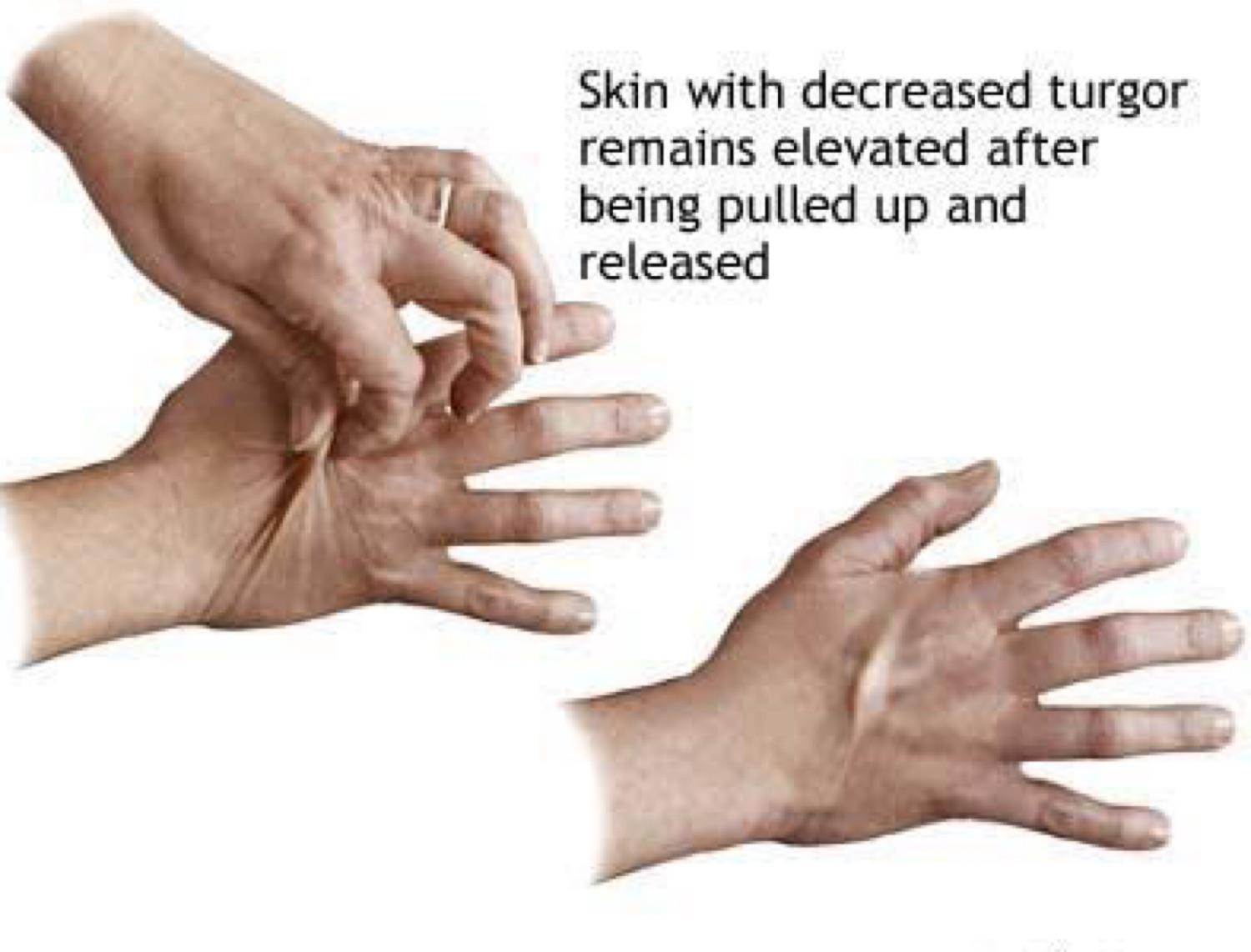 Skin Turgor Test